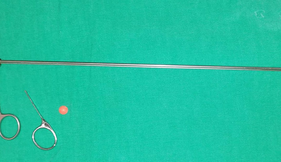 Tras dificultoso procedimiento salvan a un niño que aspiró un objeto de plástico