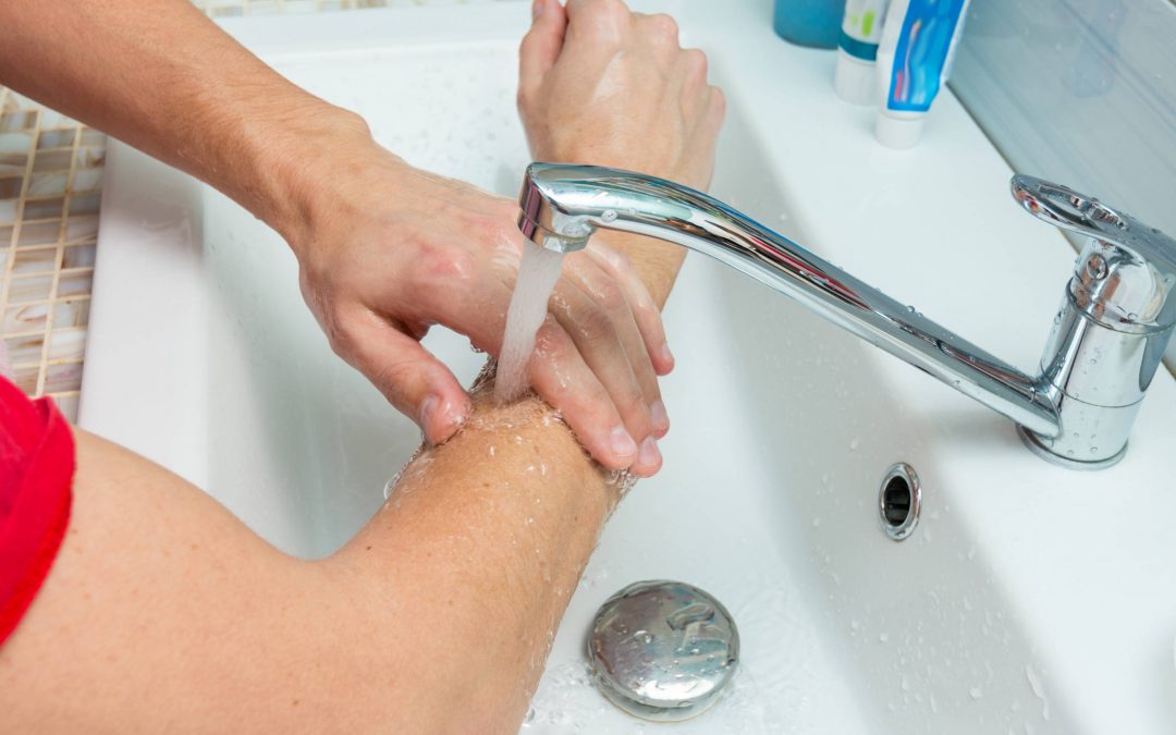 ¿Cómo tratar las quemaduras?