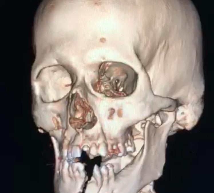 Clínicas: paciente politraumatizado fue sometido a compleja cirugía reconstructiva