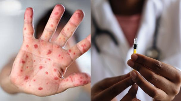 Salud pública atenta a la investigación de la viruela del mono