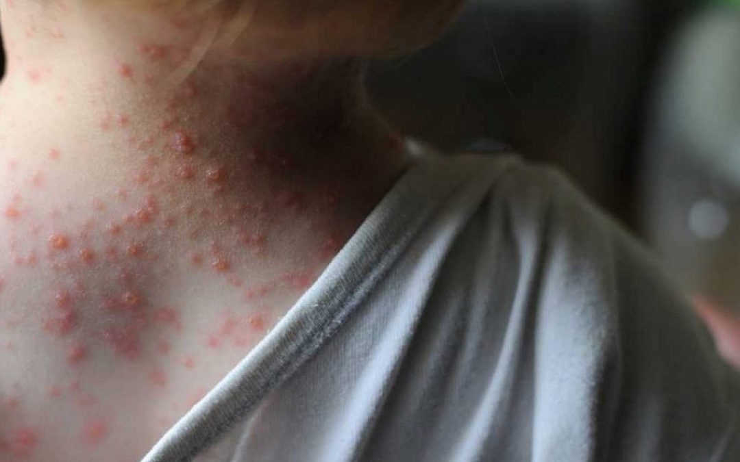 Viruela del mono: EEUU distribuirá vacunas entre la población más susceptible