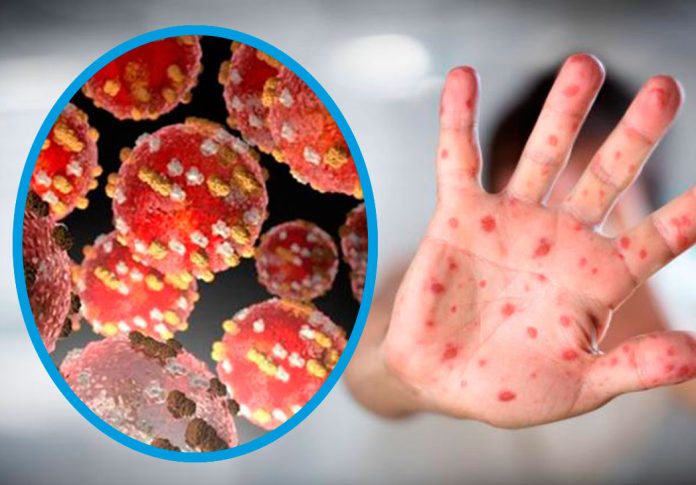 ¿Viruela del mono, qué es? Medicina UNA da detalles sobre la enfermedad