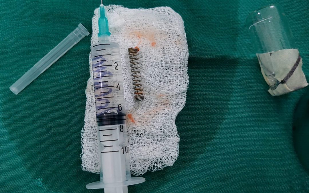 Niño de 5 años tragó un resorte y se le fue a los pulmones