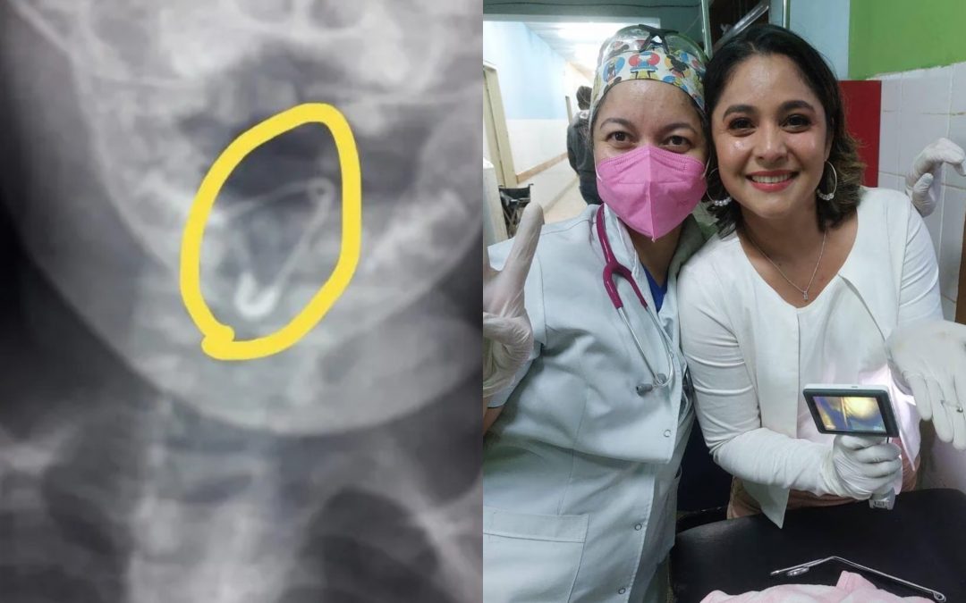 Coronel Oviedo: bebé tragó un prendedor y doctoras le salvan la vida