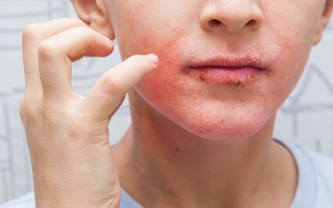 Reportan incremento de casos de enfermedad boca, manos y pies en niños en Clínicas