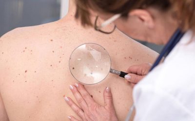 Desde el Ministerio de Salud instan a controlar los lunares