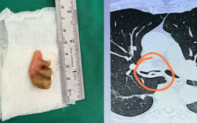 Médicos logran extraer prótesis dental del bronquio de un anciano