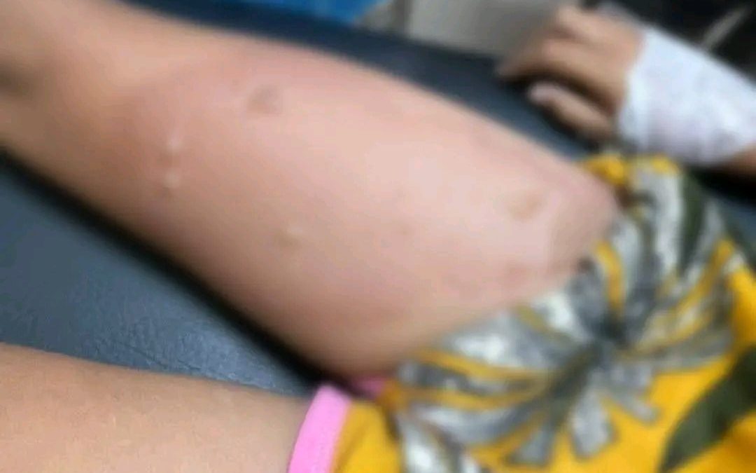 Padrastro imputado por quemar con comida caliente a niña de 6 años