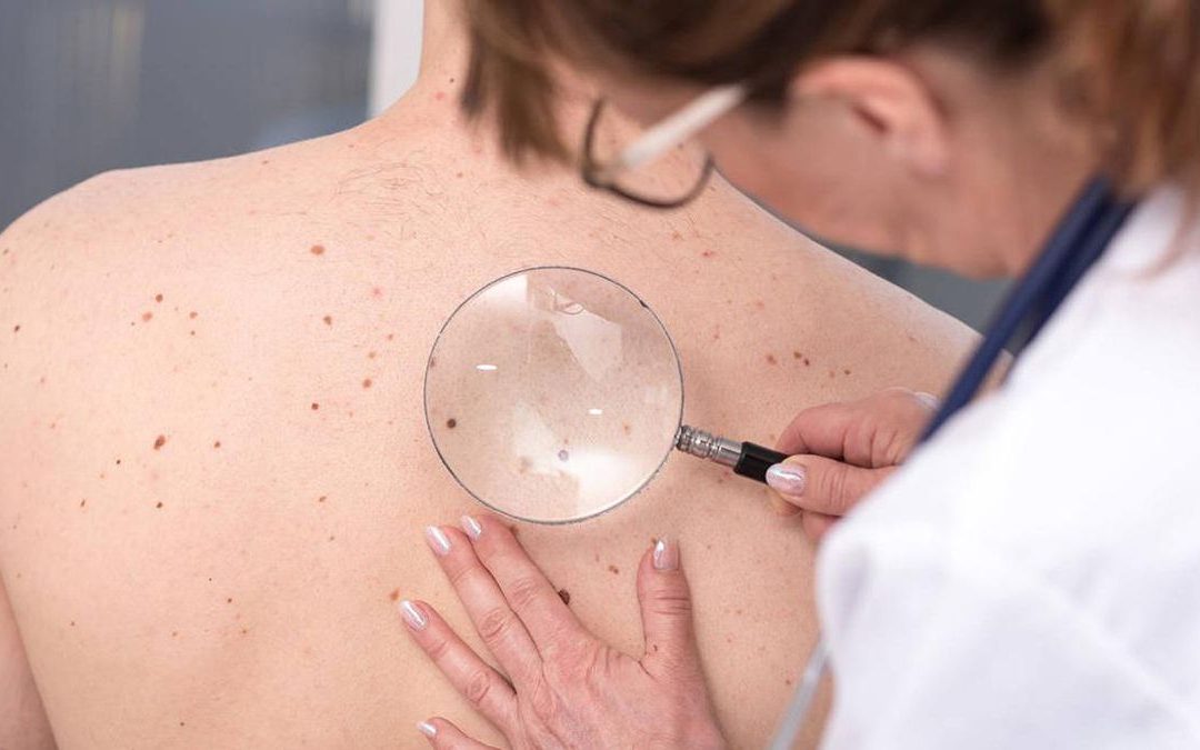 Día Mundial del Melanoma: instan a realizar un control sobre los lunares