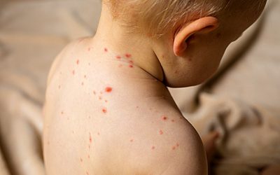 Confirman 16 casos de sarampión en San Pedro