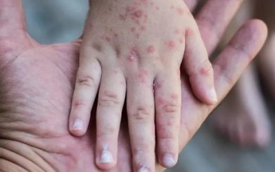 Sarampión: Salud reporta 7 casos confirmados y 12 sospechosos