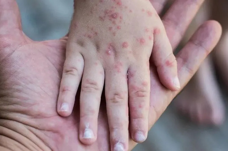 Sarampión: Salud reporta 7 casos confirmados y 12 sospechosos