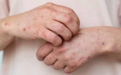 Salud emite alerta epidemiológica ante nuevos brotes de sarampión 