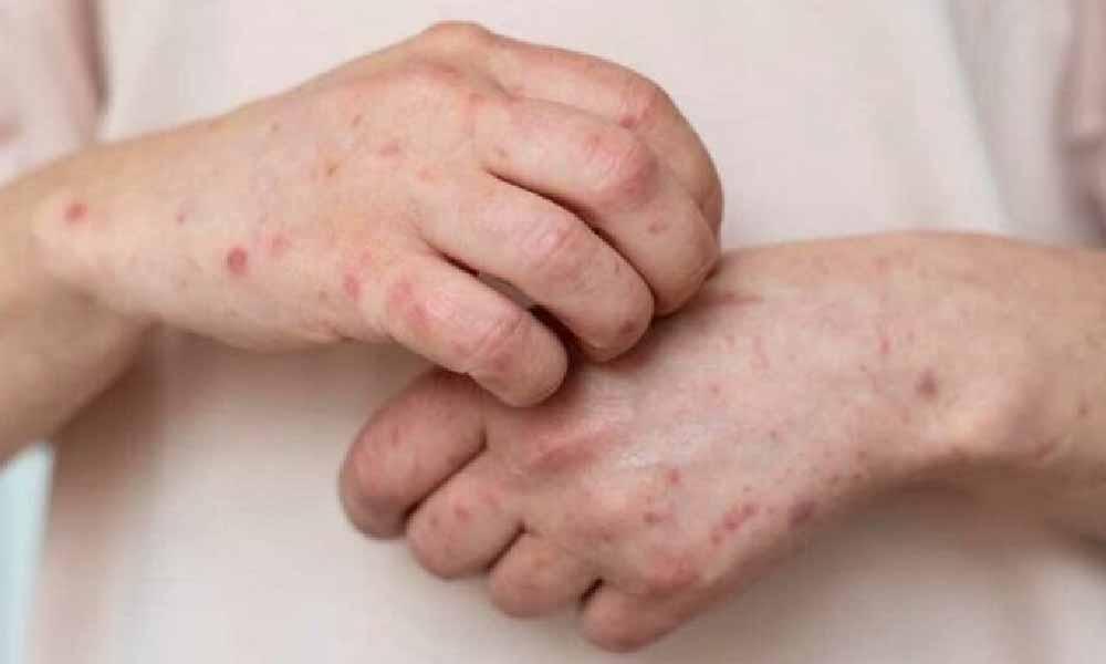 Confirman caso de sarampión en un niño oriundo de San Pedro