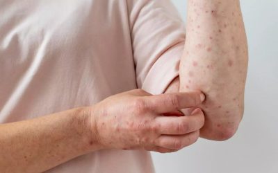 En lo que va del 2025, suman 218 los casos de lepra en el país