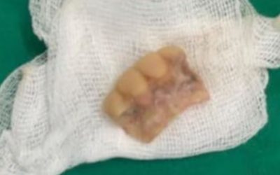 Médicos del Ineram extraen prótesis dental de la laringe de un hombre