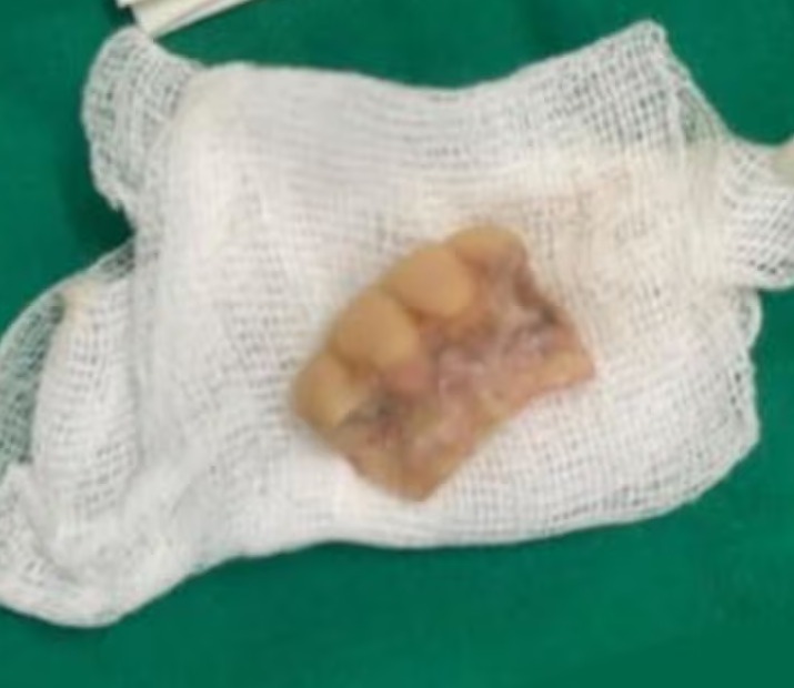 Médicos del Ineram extraen prótesis dental de la laringe de un hombre