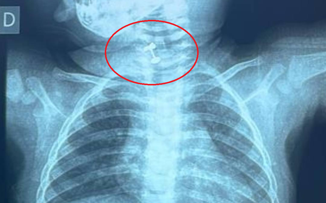 Ineram: salvan a beba de morir asfixiada luego de tragar su arito