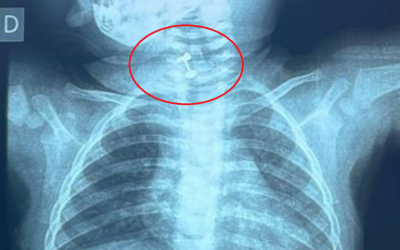 Ineram: salvan a beba de morir asfixiada luego de tragar su arito