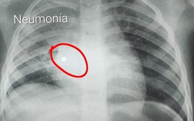 Niña de 4 años tragó un collar de perlas: “Causó una catástrofe en los pulmones”