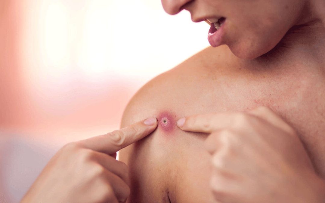 Forúnculo o susu’a: especialista explica las causas de esta infección