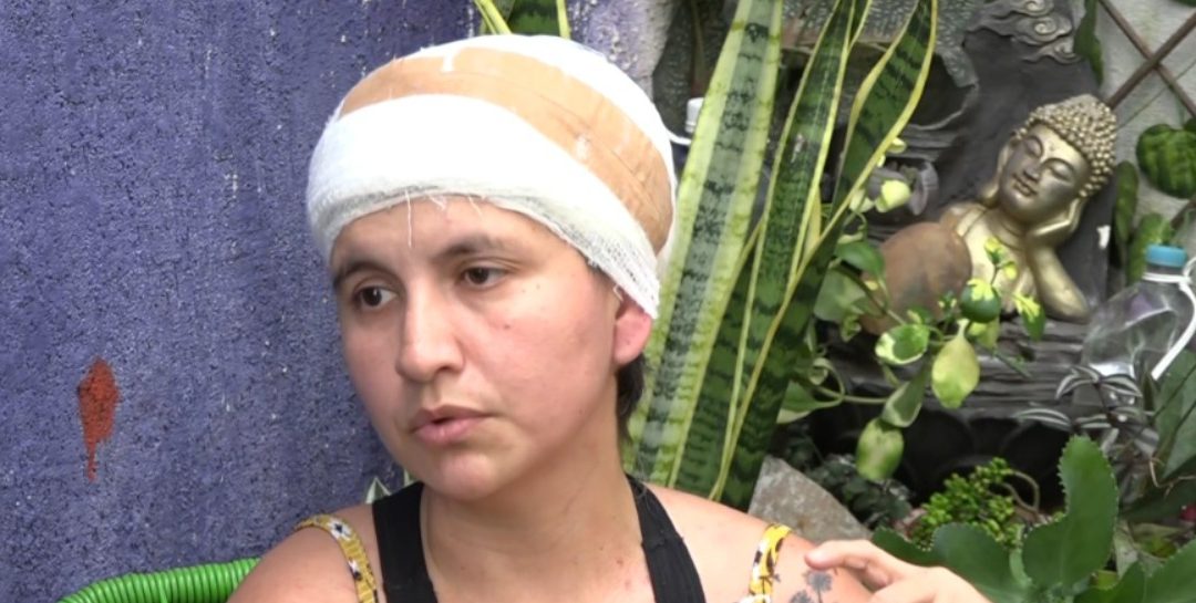 Mujer que quedó sin cuero cabelludo tras accidente necesita ayuda